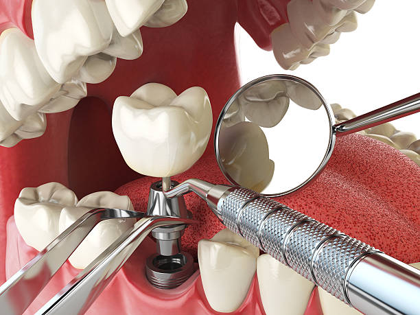 Best Emergency Tooth Extraction in Alamo, TN